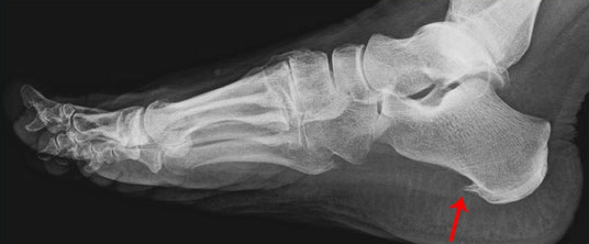 踵骨棘（かかとの痛み） | 近江八幡の整体【外反母趾・足の痛み専門】よしむら接骨院・整体院